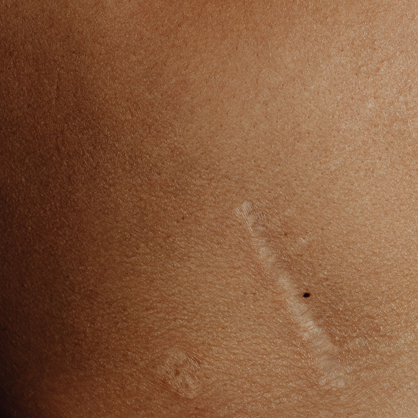 Scar Revision