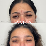 Botox & Wrinkle Relaxers