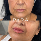 Dermal Fillers