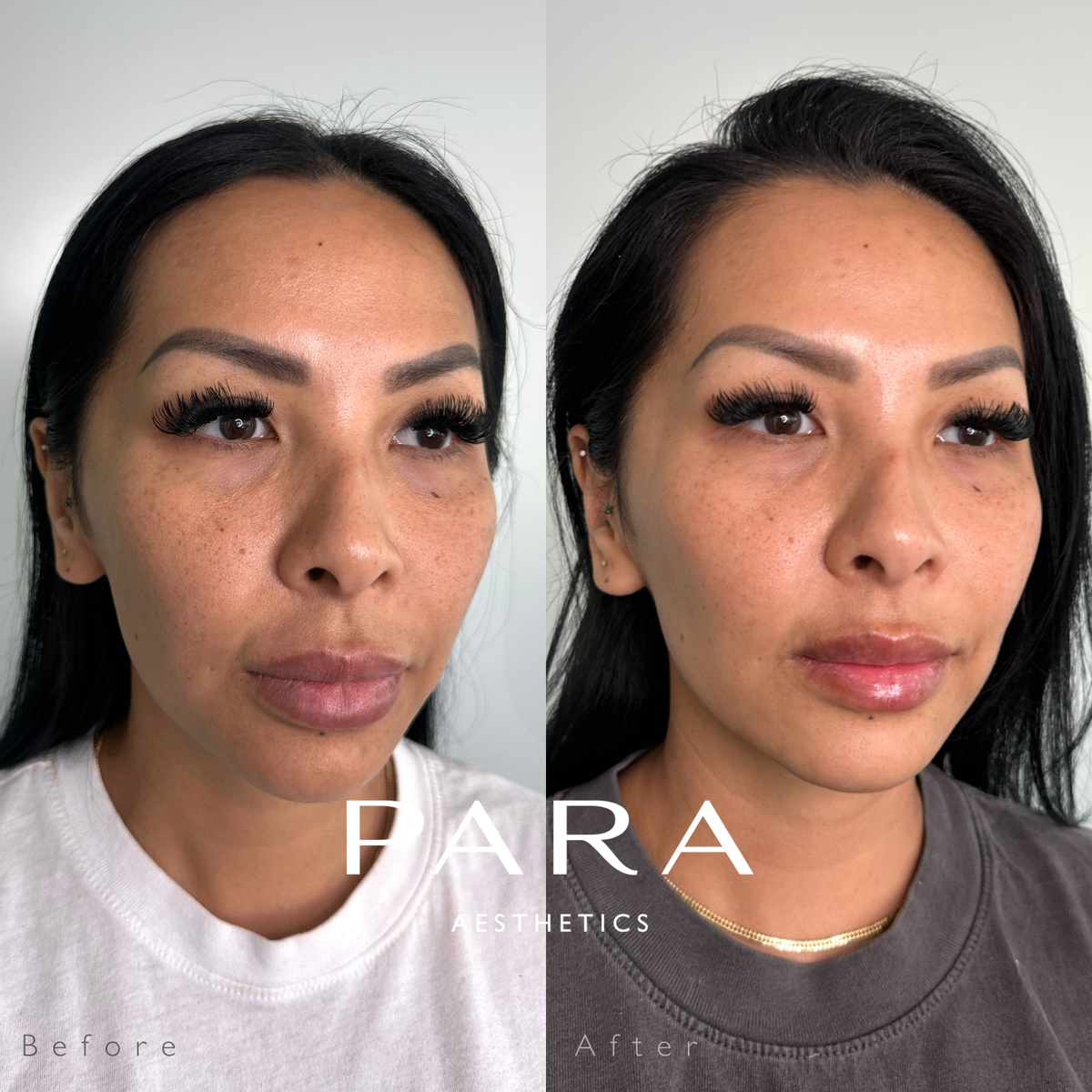 Medical Grade Microneedling