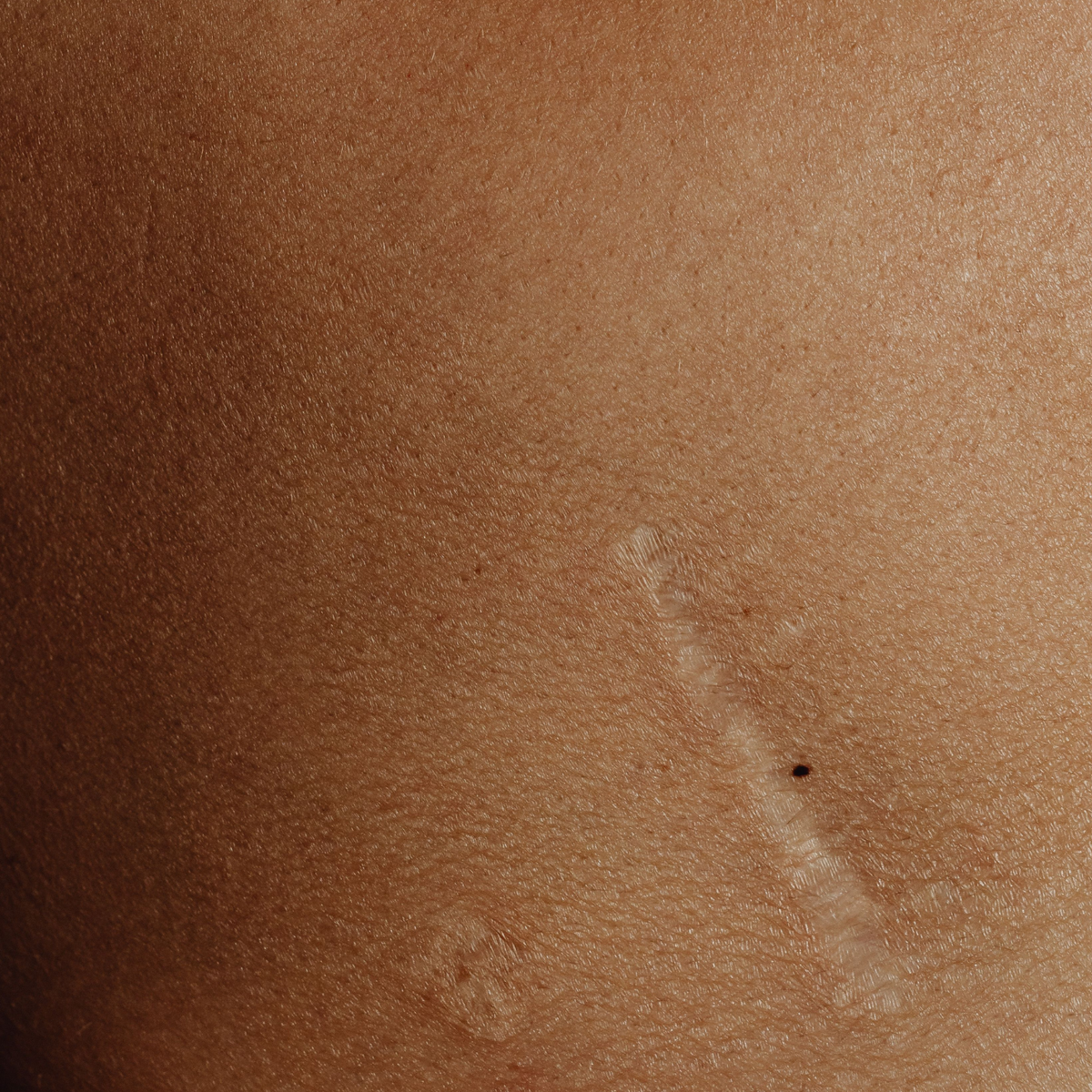 Scar Revision
