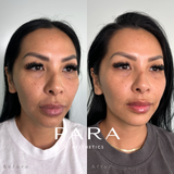 Medical Grade Microneedling