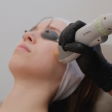 Laser Genesis Facial