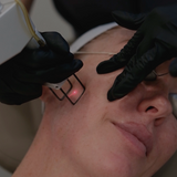 CO2 Cool Laser Resurfacing